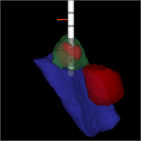 Image of guided DBS: import to programming software